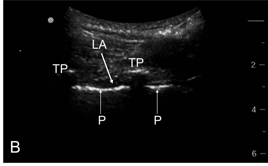 deposition of local anesthetic