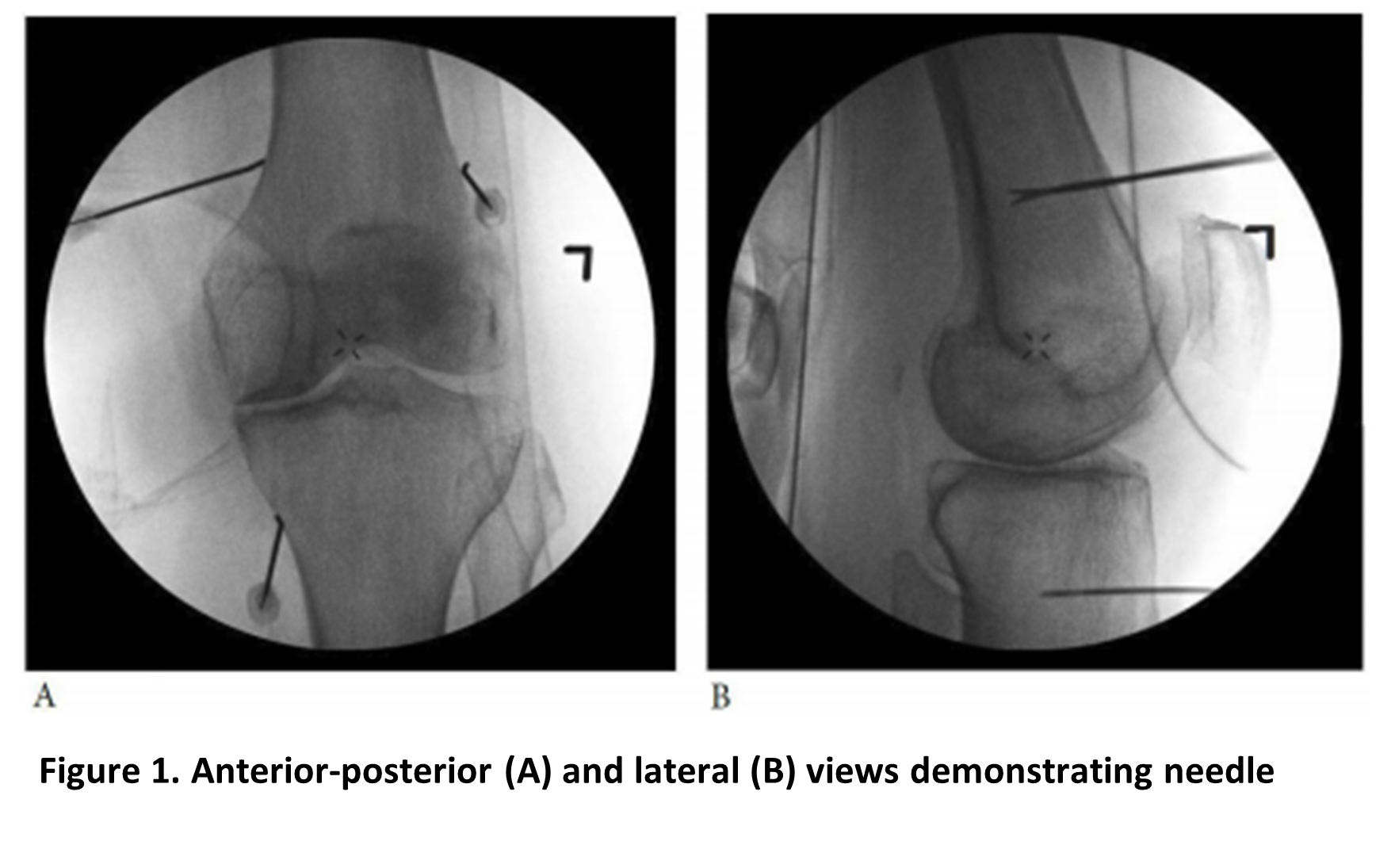 Figure 1. Anterior-posterior and lateral views demonstrating needle