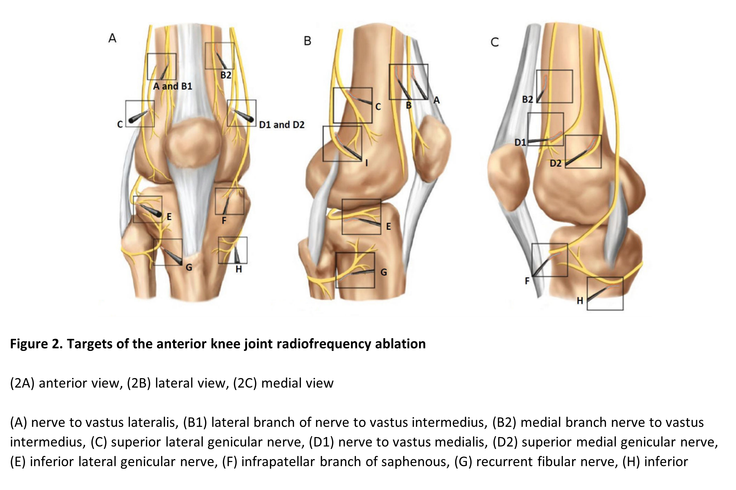 Figure 2. Targets of the anterior knee joint radiofrequency ablation