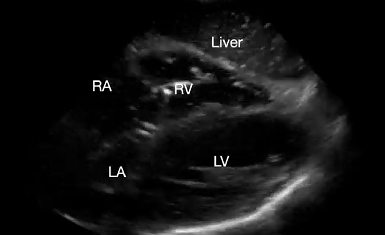 POCUS Spotlight Cardiac: True PEA