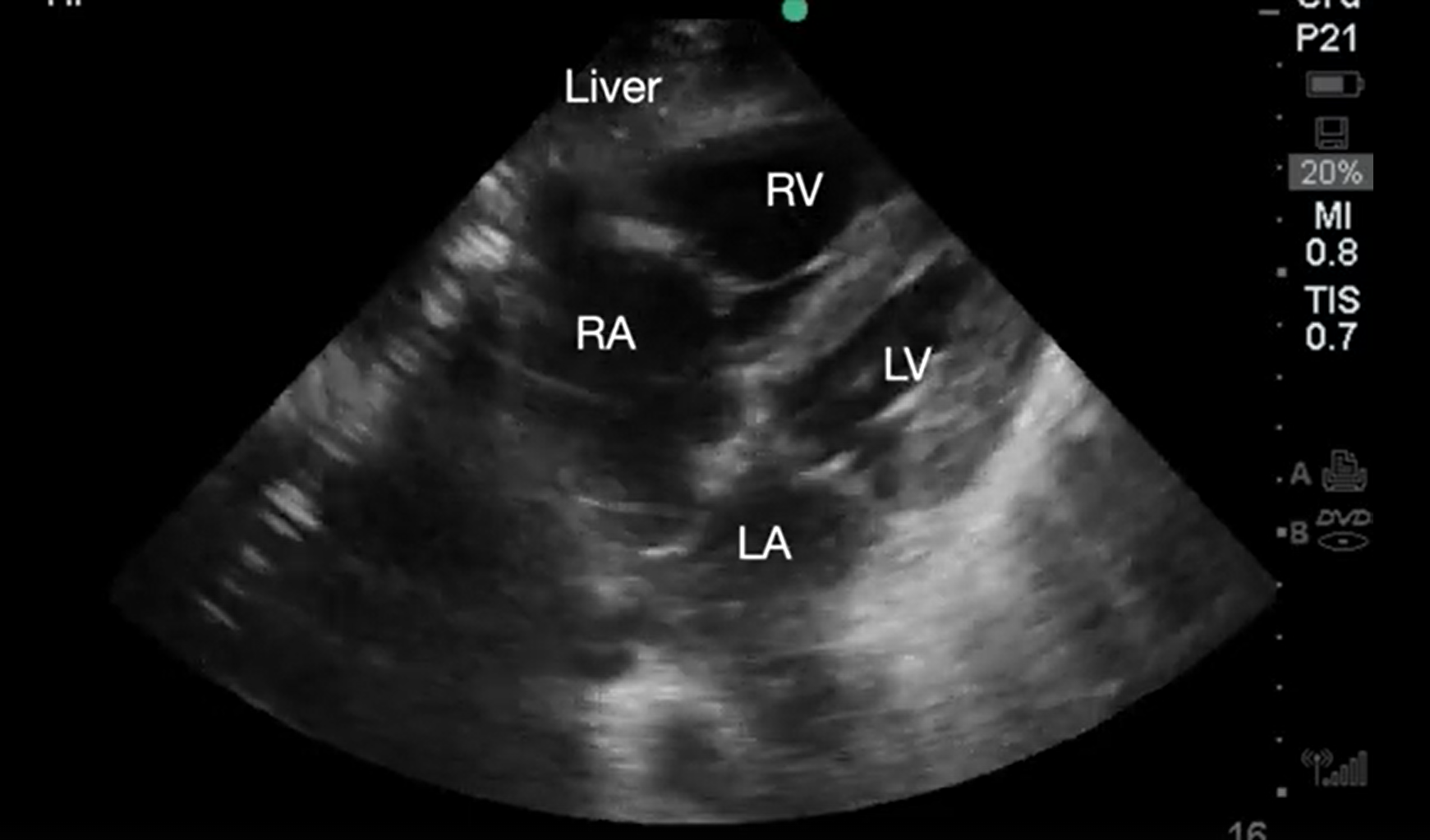 Supplemental Video 5, Subcostal 4-chaber view demonstrating dilated and depressed right ventricular function.