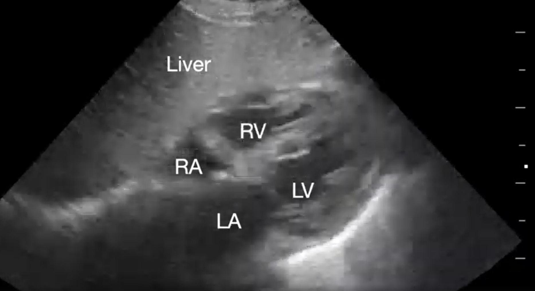 Supplemental Video 7. Demonstrating underfilled heart.