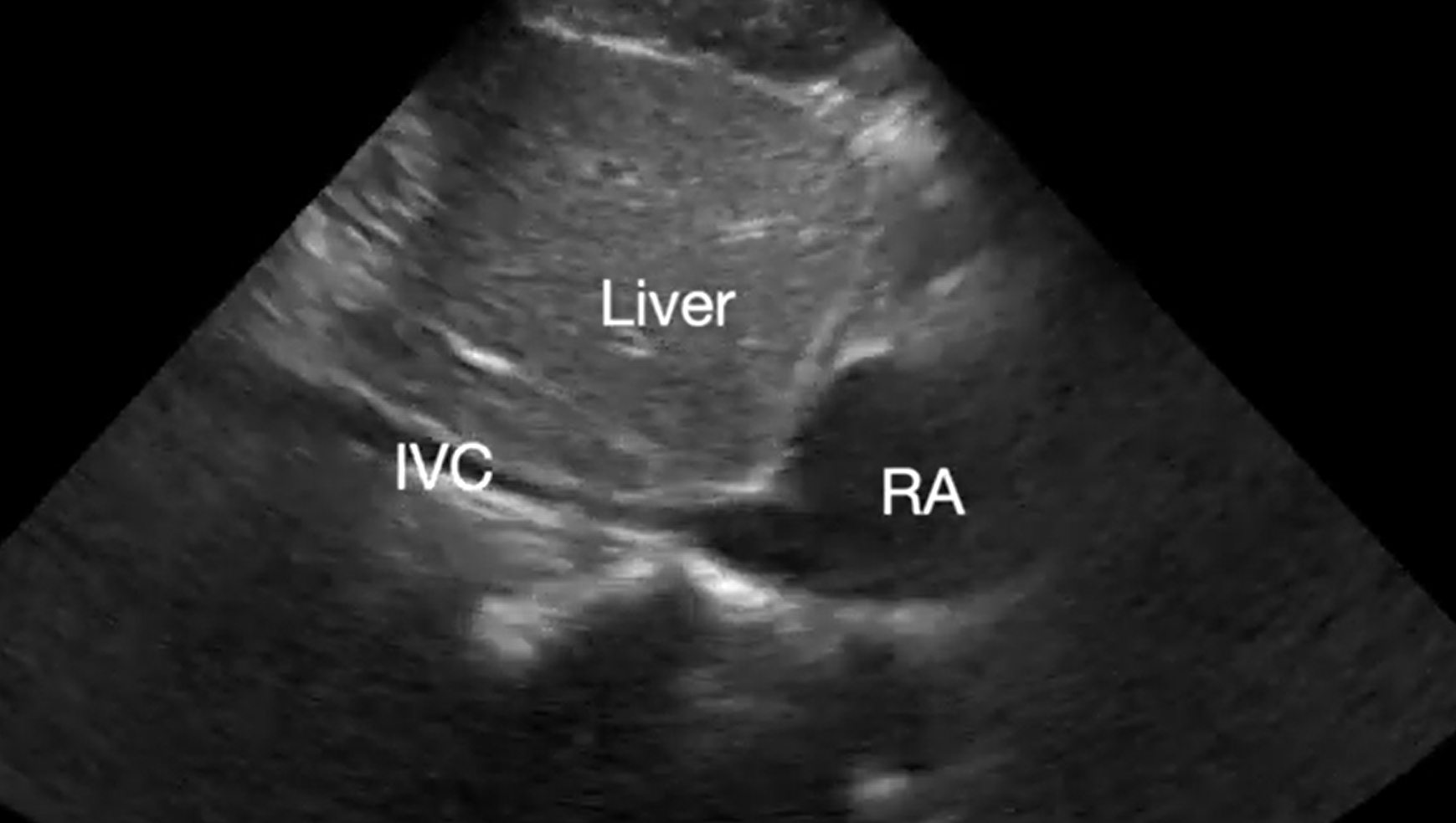 Supplemental Video 8. Demonstrating small and collapsible inferior vena cava.